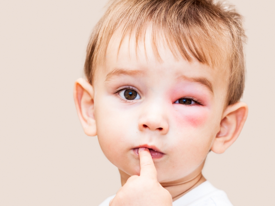 Small child with bruised left eye